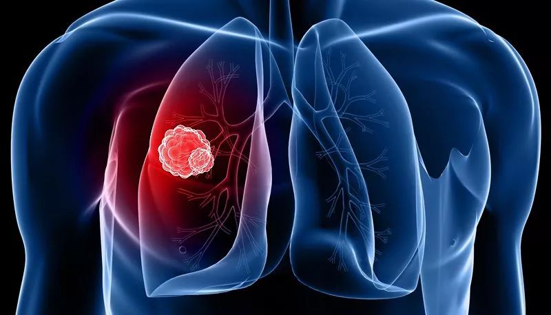 肺癌细胞“家谱”可揭示癌症发展进程
