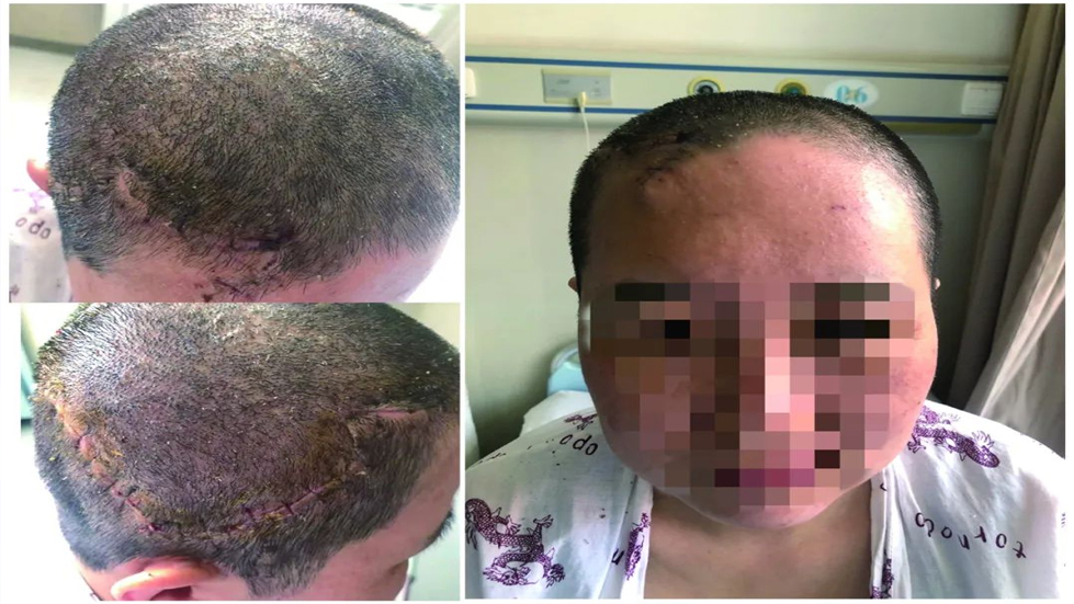 血管瘤患者的救赎之路：王女士的故事