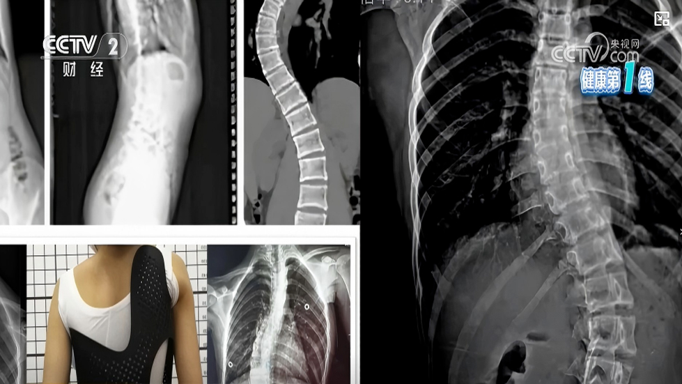 脊柱侧弯保守治疗全解析｜非手术手段，专业科普一看就懂